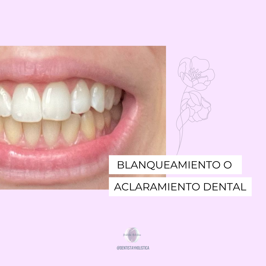 Blanqueamiento o aclaramiento dental